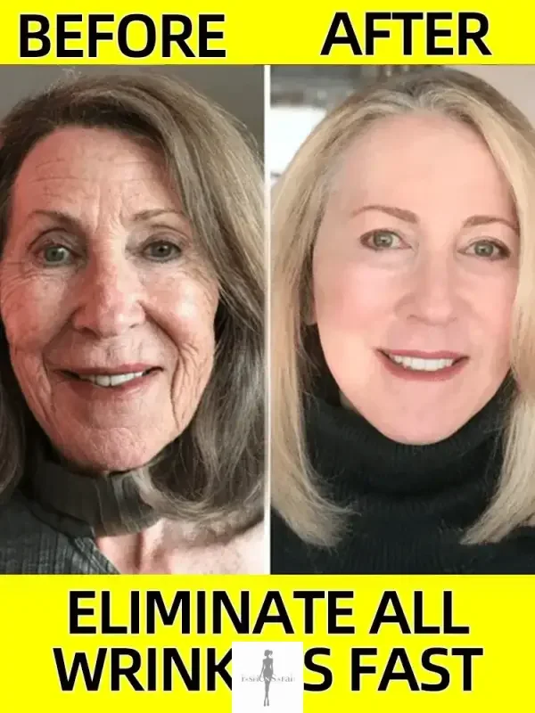 Before and after results of Anti-Aging Serum Wrinkle Remover showing wrinkle reduction effort